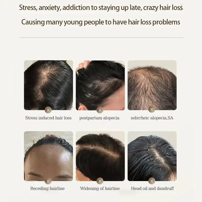 SF52 traitements du cuir chevelu produit de croissance des cheveux prévenir le traitement de la calvitie Anti perte de cheveux sérum Spray cuir chevelu barbe beauté soins capillaires Pr